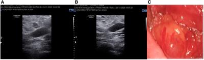 Ultrasound-guided approach to surgery for nodal recurrence following lateral neck dissection for differentiated thyroid carcinoma. A single institution experience